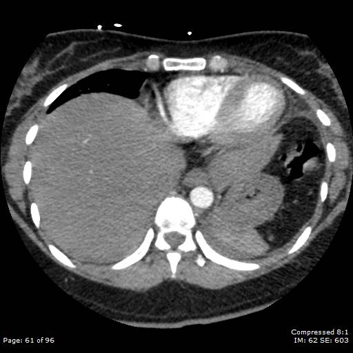 Bilateral pulmonary emboli with Hampton hump sign (Radiopaedia 54070-60246 Axial C+ CTPA 58).jpg