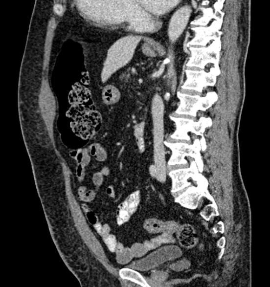 File:Bilateral rectus sheath hematomas (Radiopaedia 50778-56252 B 46).jpg