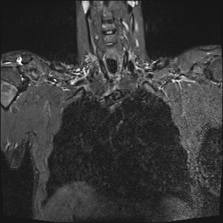 File:Bilateral spinoglenoid notch ganglion cysts (Radiopaedia 29577-30082 Coronal STIR 8).jpg