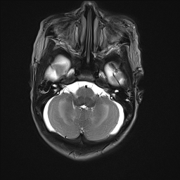 File:Bilateral subdural hemorrhage and parietal skull fracture (Radiopaedia 26058-26190 Axial T2 9).png