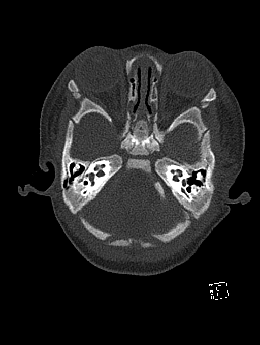 Bilateral subdural hemorrhage and parietal skull fracture (Radiopaedia 26058-26192 Axial bone window 108).png