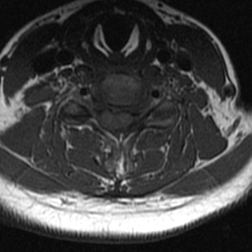 File:Bilateral tortuous vertebral arteries (Radiopaedia 19070-19039 Axial T2 5).jpg