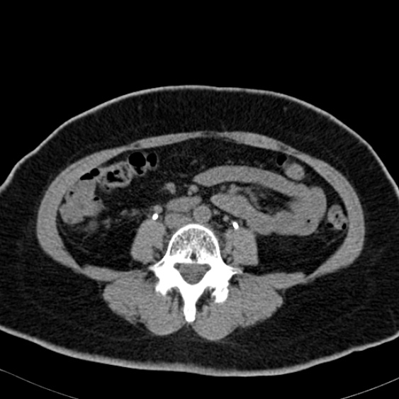 Bilateral ureteric stents (Radiopaedia 48795-53825 Axial non-contrast 34).jpg