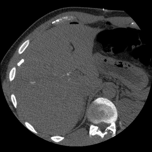 Bile leak from liver traumatic laceration (Radiopaedia 63463-72077 Axial Biliscopin 31).jpg