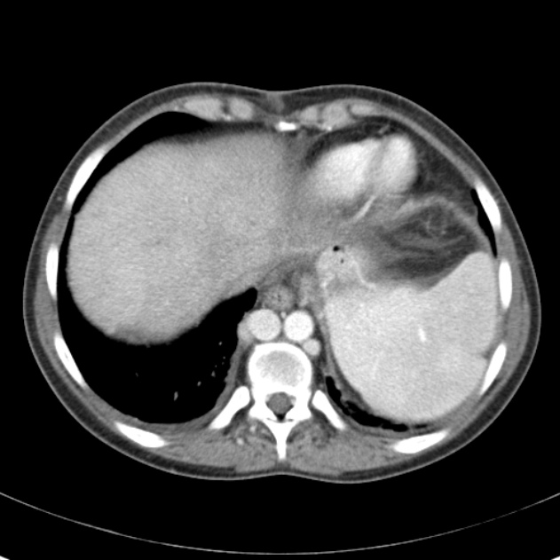 Biliary necrosis - liver transplant (Radiopaedia 21876-21846 B 8).jpg