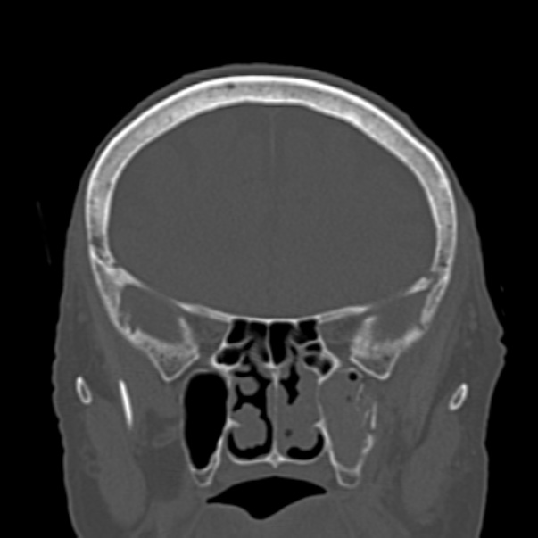 Biparietal osteodystrophy (Radiopaedia 46109-50463 Coronal bone window 37).jpg