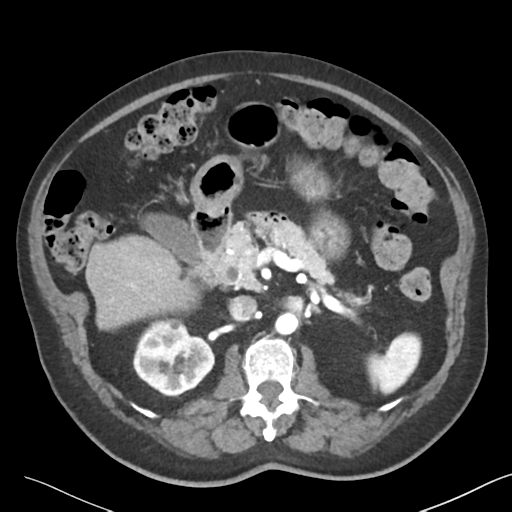 File:Bladder papillary urothelial carcinoma (Radiopaedia 48119-52951 A 17).png