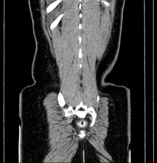 Blind-ending branch of a bifid ureter (Radiopaedia 61159-69048 F 65).jpg