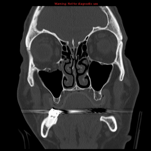 File:Blowout fracture with inferior rectus entrapment (Radiopaedia 12418-12673 Coronal bone window 6).jpg