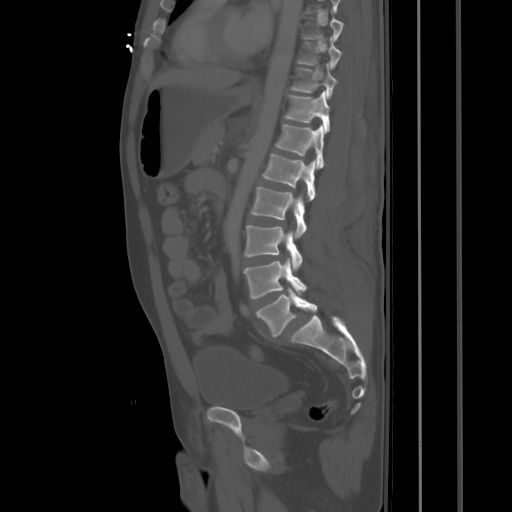 File:Blunt abdominal trauma with solid organ and musculoskelatal injury with active extravasation (Radiopaedia 68364-77895 Sagittal bone window 58).jpg