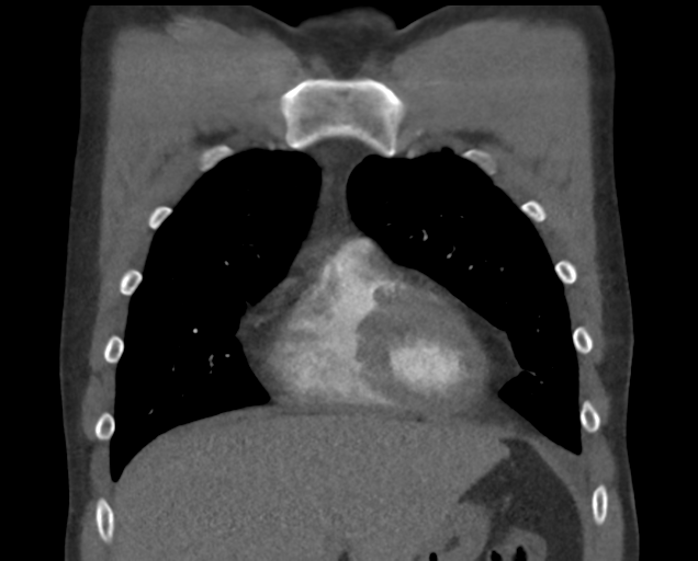 File:Boerhaave syndrome (Radiopaedia 39382-41660 C 25).png