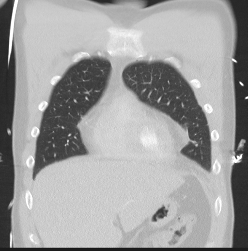 Boerhaave syndrome (Radiopaedia 39382-41661 Coronal lung window 12).png