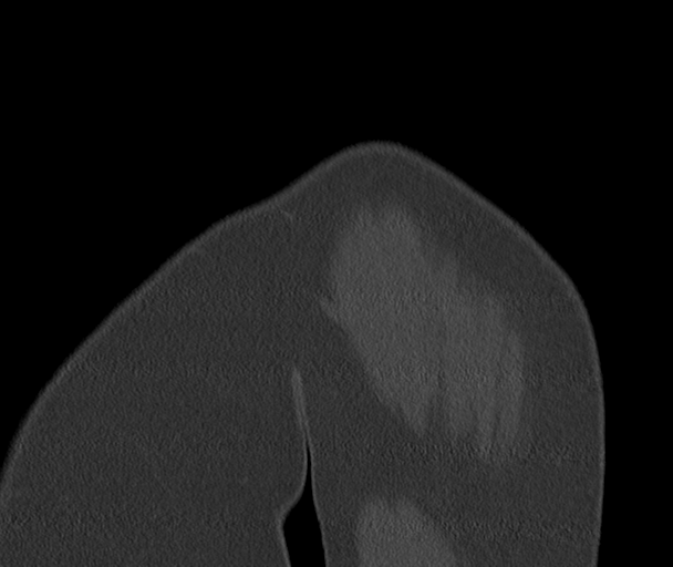 Bony Bankart and Hill-Sachs lesions (Radiopaedia 33622-34727 Sagittal bone window 5).png