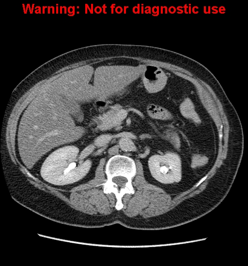 File:Bosniak renal cyst - type II (Radiopaedia 23404-23468 F 21).jpg
