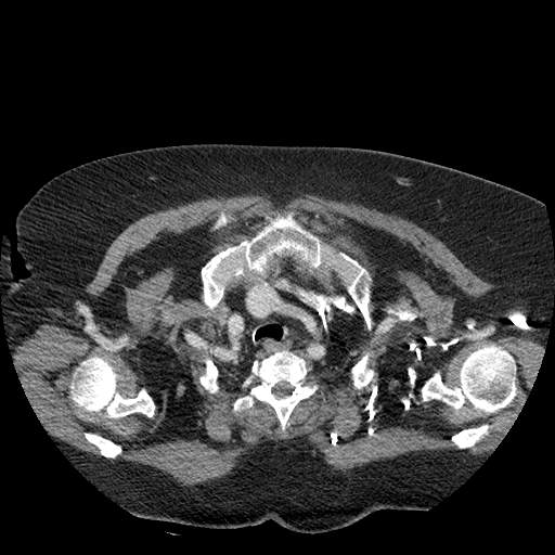 Bovine aortic arch - right internal mammary vein drains into the superior vena cava (Radiopaedia 63296-71875 A 18).jpg