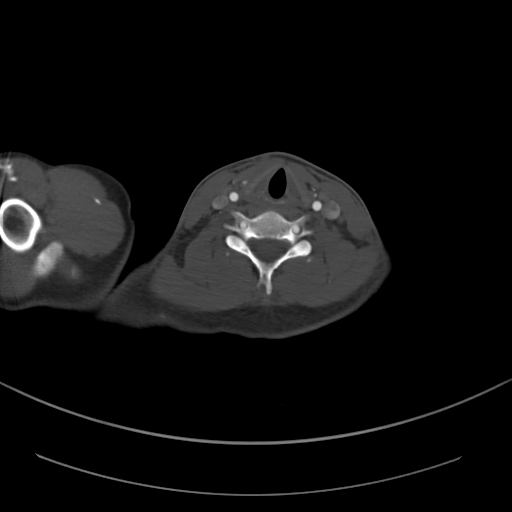 Brachiocephalic trunk pseudoaneurysm (Radiopaedia 70978-81191 Axial bone window 28).jpg