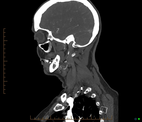Brachiocephalic trunk stenosis (Radiopaedia 87242-103519 C 49).jpg