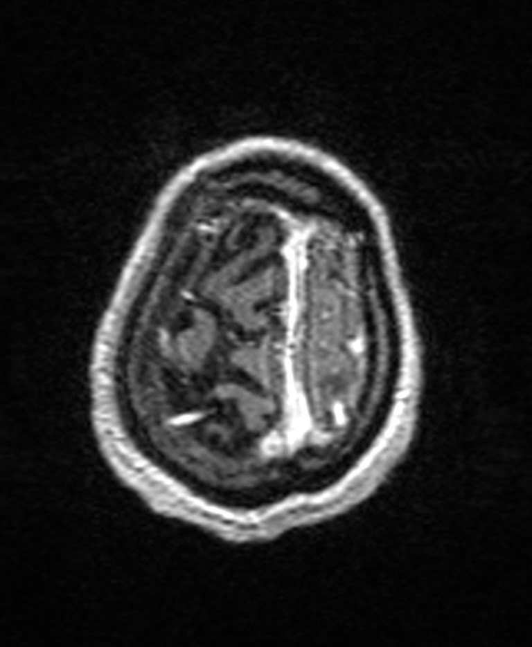 Brain abscess with dual rim sign (Radiopaedia 87566-103938 Axial T1 C+ 145).jpg