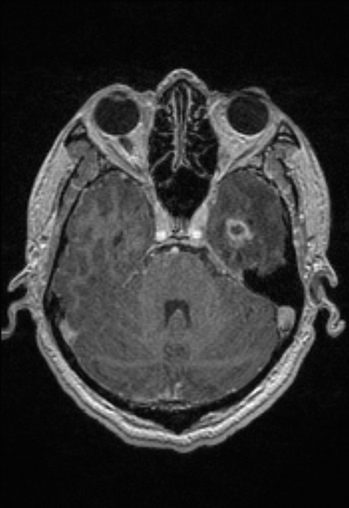 Brain abscess with ventriculitis (Radiopaedia 85703-101495 Axial T1 C+ 57).jpg