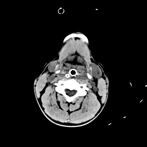File:Brain contusions, internal carotid artery dissection and base of skull fracture (Radiopaedia 34089-35339 Axial non-contrast 2).png