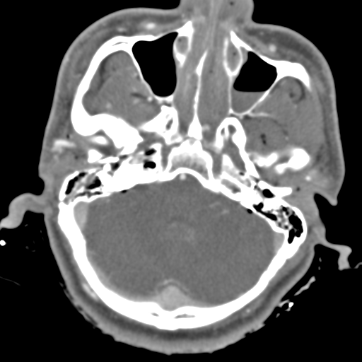 Brain contusions, internal carotid artery dissection and base of skull fracture (Radiopaedia 34089-35339 D 43).png