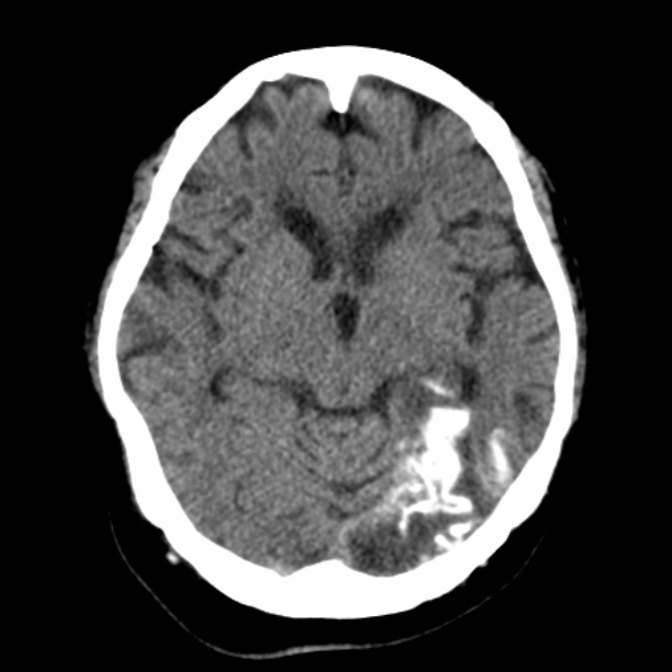 Brain cortical laminar necrosis (Radiopaedia 25822-25971 Axial non-contrast 19).jpg