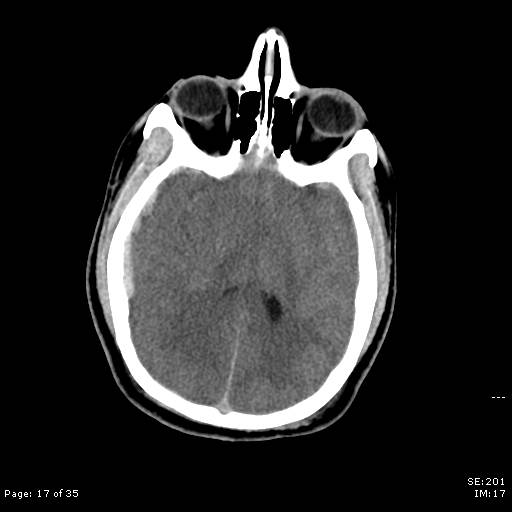File:Brain death after motor vehicle collision (Radiopaedia 88470-105114 Axial non-contrast 17).jpg
