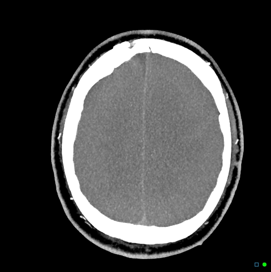 Brain death on MRI and CT angiography (Radiopaedia 42560-45841 B 16).jpg