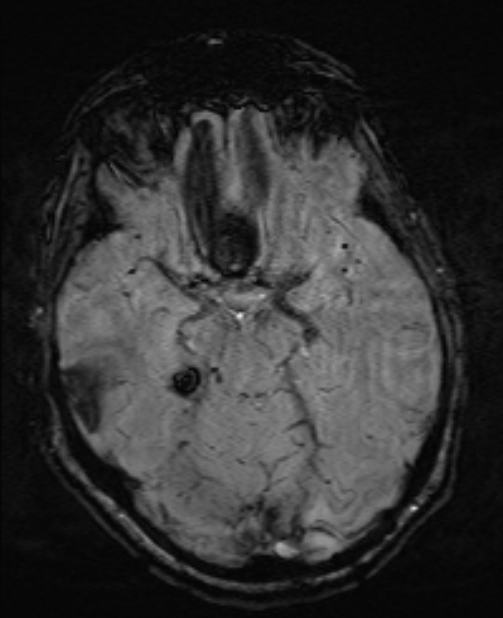 Brain metastases - lung cancer primary (Radiopaedia 75060-86115 Axial SWI 25).jpg