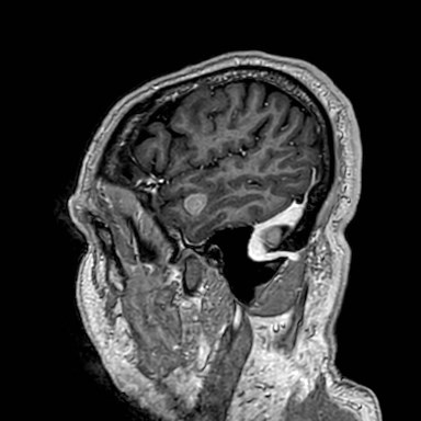 Brain metastases from lung cancer (Radiopaedia 83839-99028 Sagittal T1 C+ 56).jpg