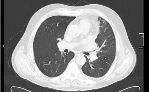 Brain metastases from squamocellular lung cancer (Radiopaedia 56515-63219 Axial lung window 33).jpg