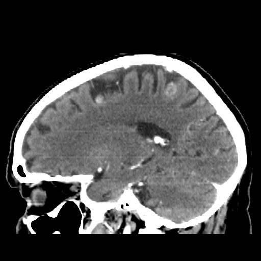Brain metastasis (Radiopaedia 42617-45760 D 18).jpg