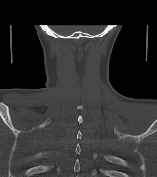 Branchial cleft cyst (Radiopaedia 31167-31875 Coronal bone window 55).jpg