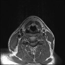 File:Branchial cleft cyst (Radiopaedia 31167-31876 Axial T1 5).jpg