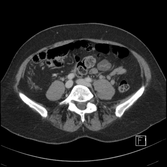 File:Breast metastases from renal cell cancer (Radiopaedia 79220-92225 C 73).jpg