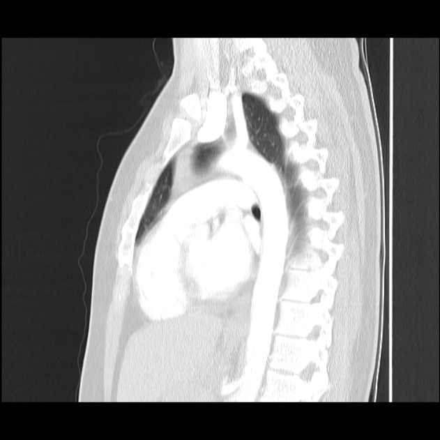 Bronchial atresia (Radiopaedia 22965-22992 Sagittal lung window 25).jpg