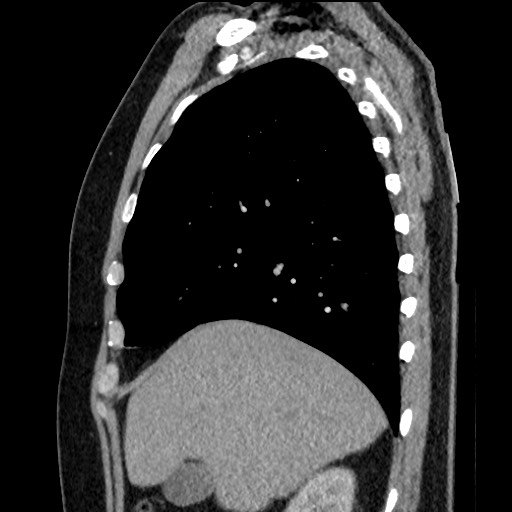 Bronchial carcinoid tumor (Radiopaedia 67377-76764 E 19).jpg