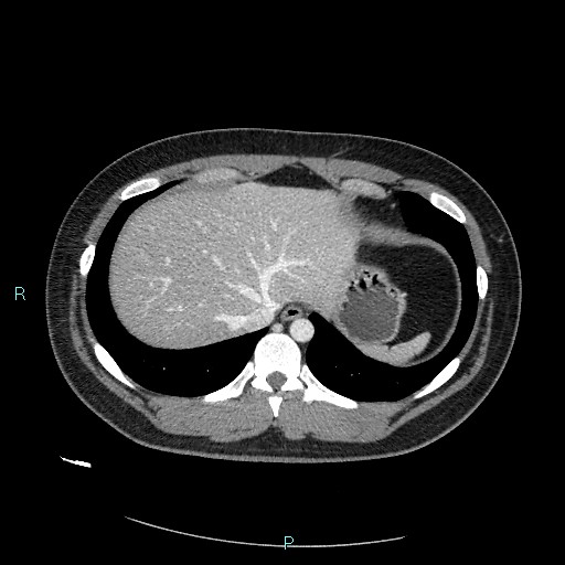 Bronchial carcinoid tumor (Radiopaedia 78272-90875 A 81).jpg