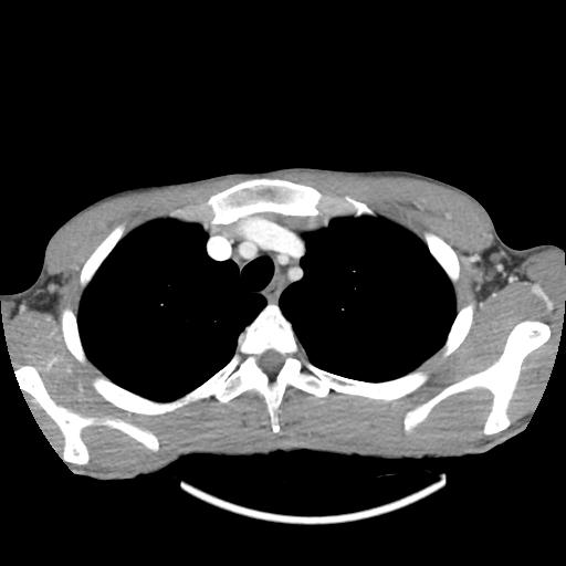 File:Bronchial carcinoid tumor causing right lower lobe collapse (Radiopaedia 83495-98594 A 7).jpg
