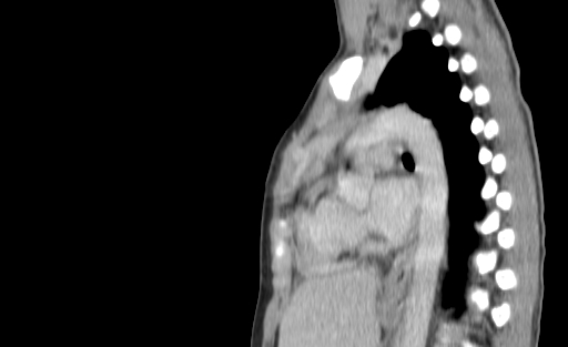 Bronchial mucoepidermoid carcinoma (Radiopaedia 57023-63895 Sagittal 139).jpg