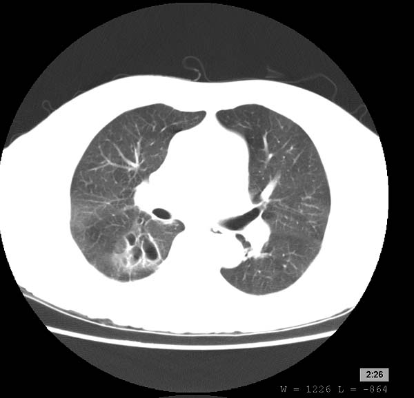 File:Bronchiectasis (Radiopaedia 11257-11621 Axial lung window 1).jpg