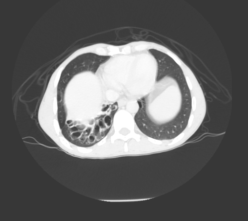 File:Bronchiectasis in Crohn disease (Radiopaedia 60311-67977 Axial lung window 17).jpg