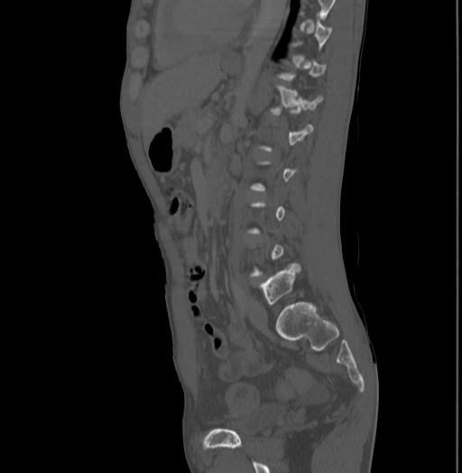 Bronchiectasis in Crohn disease (Radiopaedia 60311-67977 Sagittal bone window 153).jpg