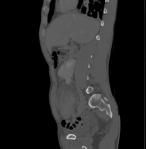 File:Bronchiectasis in Crohn disease (Radiopaedia 60311-67977 Sagittal bone window 82).jpg