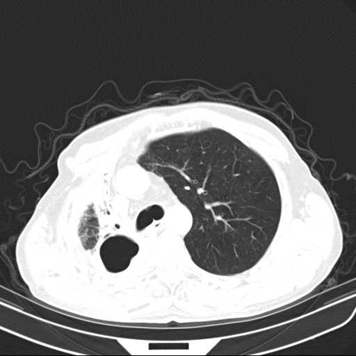 File:Bronchopleural fistula - postoperative complication (Radiopaedia 21020-20947 Axial lung window 18).jpg