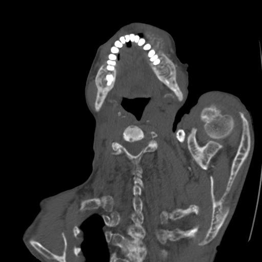 File:Brown tumor with secondary hyperparathyroidism (Radiopaedia 23591-23705 C 14).jpg