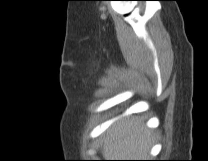 Brown tumors compressing the spinal cord (Radiopaedia 68442-77988 B 8).jpg