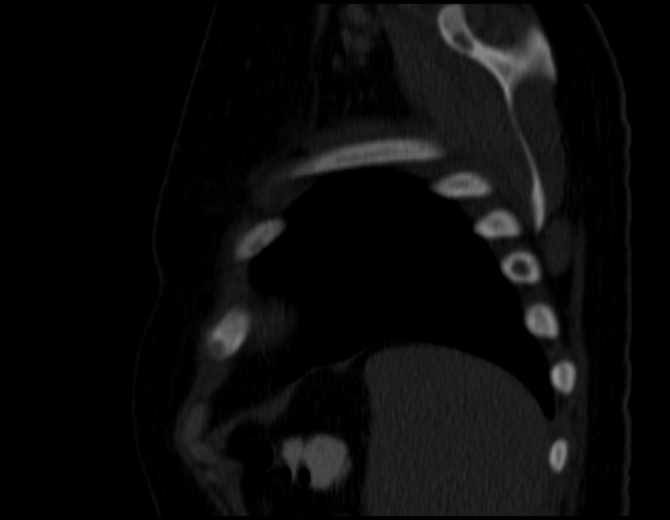 Brown tumors compressing the spinal cord (Radiopaedia 68442-77988 Sagittal bone window 49).jpg