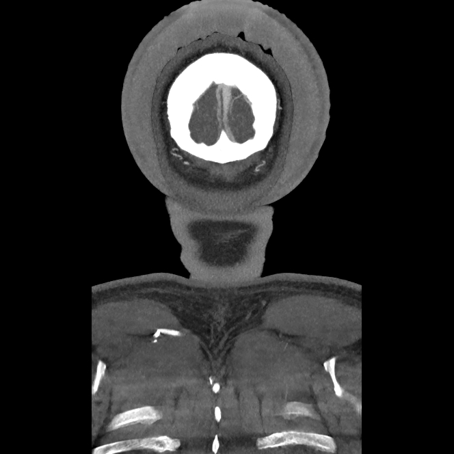 Buccal fat pad arteriovenous malformation (Radiopaedia 70936-81144 B 58).jpg