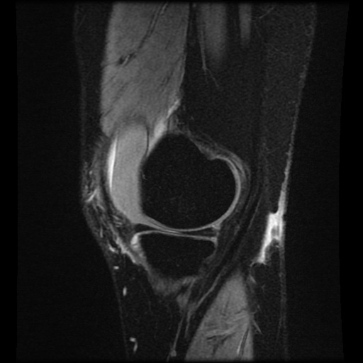 File:Bucket handle meniscus tear (Radiopaedia 56916-63751 H 68).jpg
